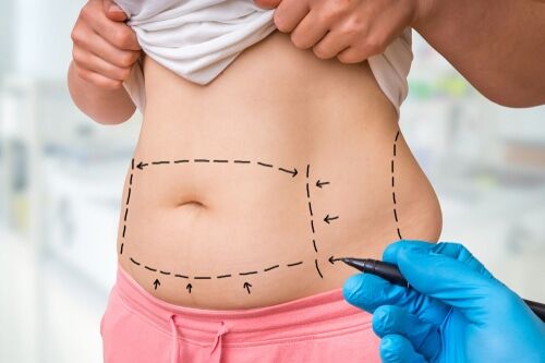 Tummy Tuck in Buffalo, NY