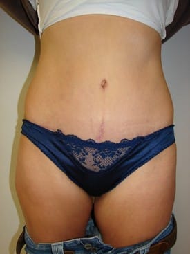 Tummy Tuck for Williamsville & Buffalo, NY